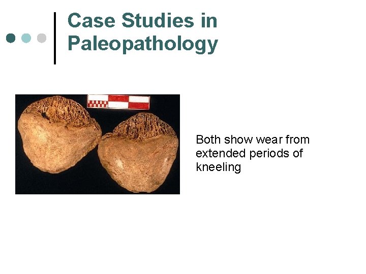 Case Studies in Paleopathology Both show wear from extended periods of kneeling 