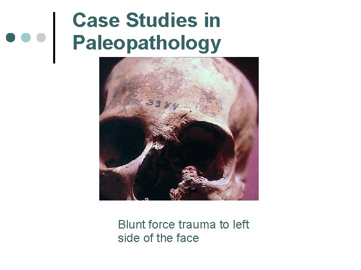 Case Studies in Paleopathology Blunt force trauma to left side of the face 