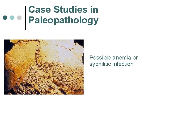 Case Studies in Paleopathology Possible anemia or syphilitic infection 