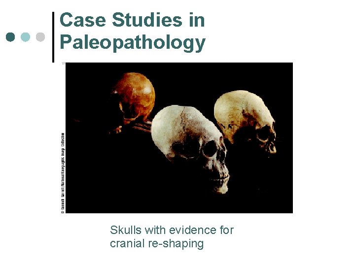 Case Studies in Paleopathology Skulls with evidence for cranial re-shaping 