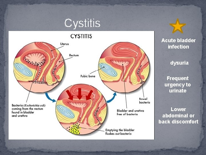 Cystitis Acute bladder infection dysuria Frequent urgency to urinate Lower abdominal or back discomfort