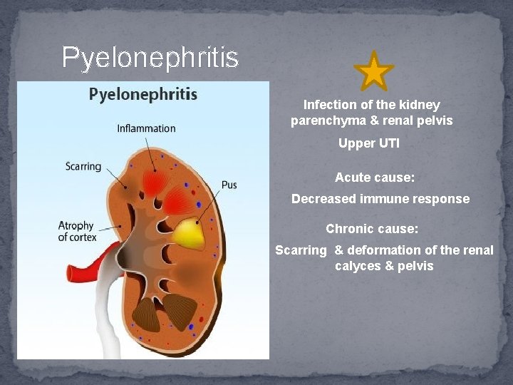 Pyelonephritis Infection of the kidney parenchyma & renal pelvis Upper UTI Acute cause: Decreased