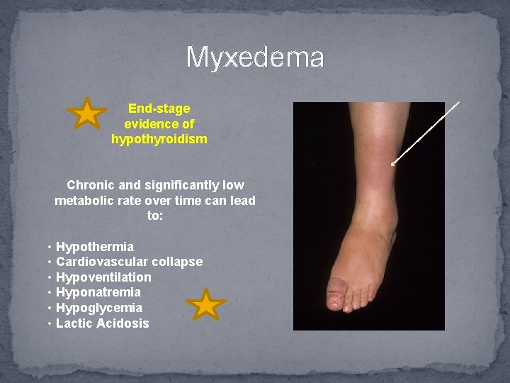 Myxedema End-stage evidence of hypothyroidism Chronic and significantly low metabolic rate over time can