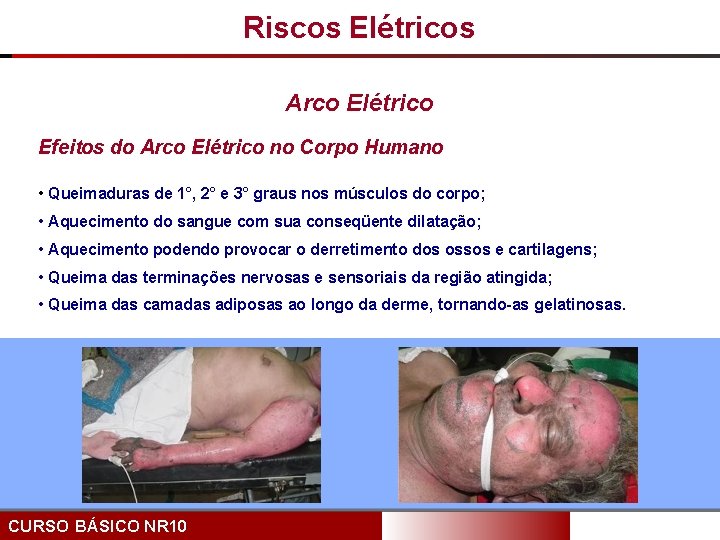 Riscos Elétricos Arco Elétrico Efeitos do Arco Elétrico no Corpo Humano • Queimaduras de