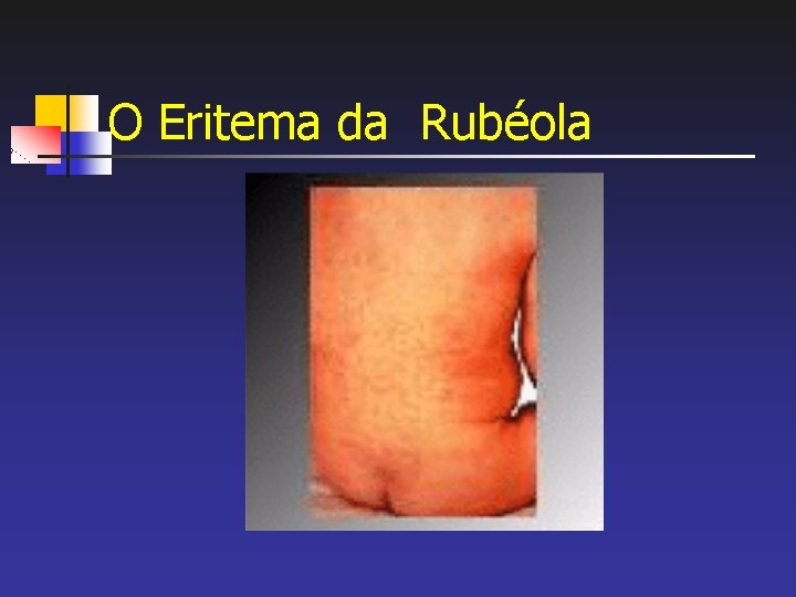 O Eritema da Rubéola 