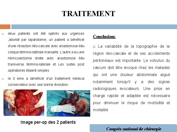 TRAITEMENT deux patients ont été opérés aux urgences , abordé par laparotomie, un patient
