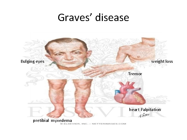 Graves’ disease Bulging eyes weight loss Tremor heart Palpitation pretibial myxedema 