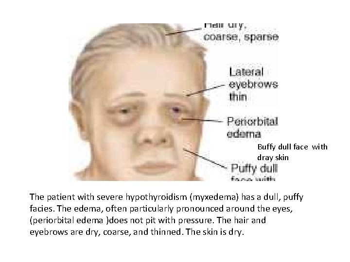 Buffy dull face with dray skin The patient with severe hypothyroidism (myxedema) has a