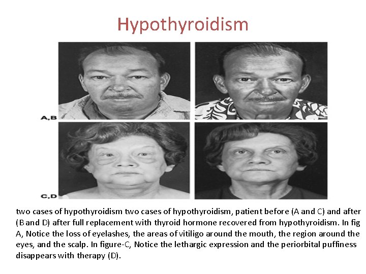 Hypothyroidism two cases of hypothyroidism, patient before (A and C) and after (B and Hypothyroidism two cases of hypothyroidism, patient before (A and C) and after (B and