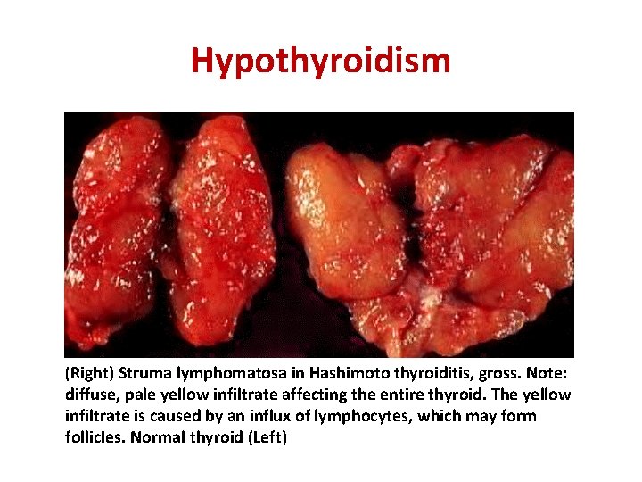 Hypothyroidism (Right) Struma lymphomatosa in Hashimoto thyroiditis, gross. Note: diffuse, pale yellow infiltrate affecting