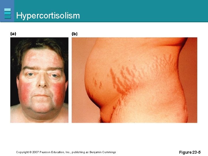 Hypercortisolism Copyright © 2007 Pearson Education, Inc. , publishing as Benjamin Cummings Figure 23