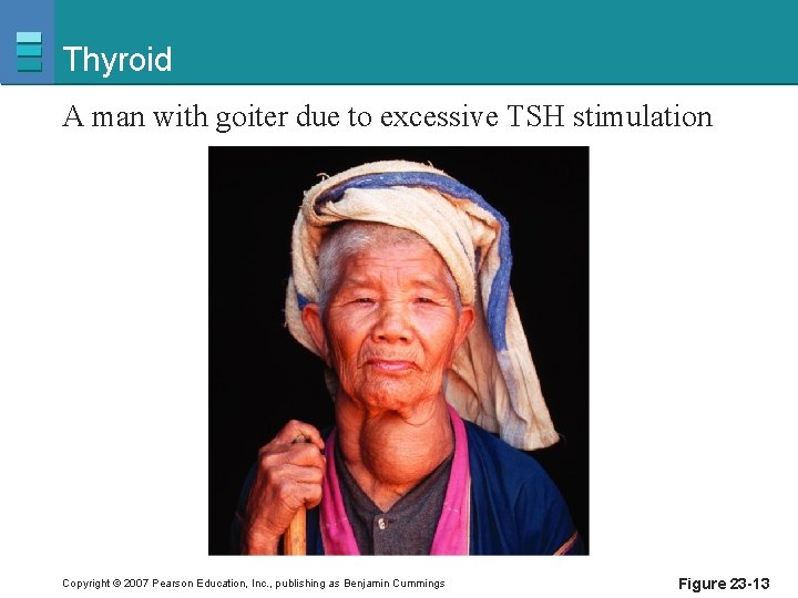 Thyroid A man with goiter due to excessive TSH stimulation Copyright © 2007 Pearson