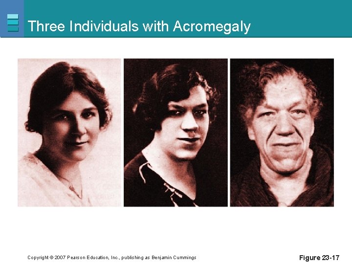 Three Individuals with Acromegaly Copyright © 2007 Pearson Education, Inc. , publishing as Benjamin