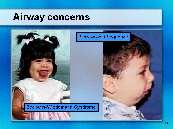 Airway concerns Pierre-Robin Sequence Beckwith-Wiedemann Syndrome 18 