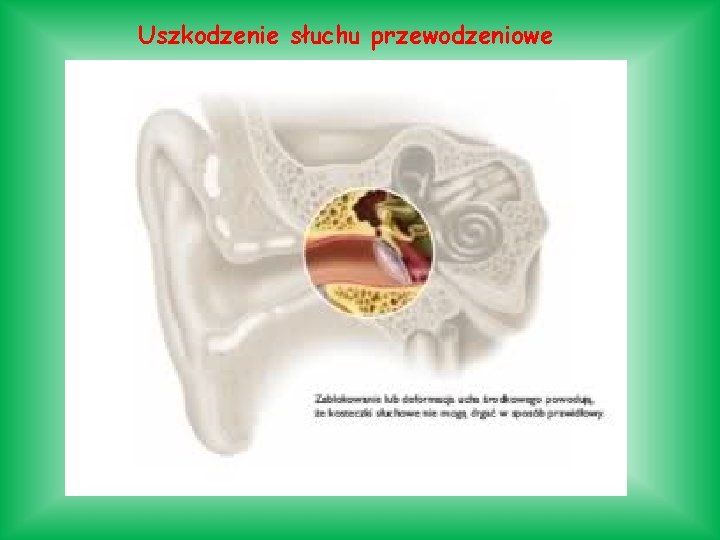 Uszkodzenie słuchu przewodzeniowe 