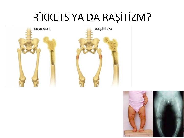 RİKKETS YA DA RAŞİTİZM? 