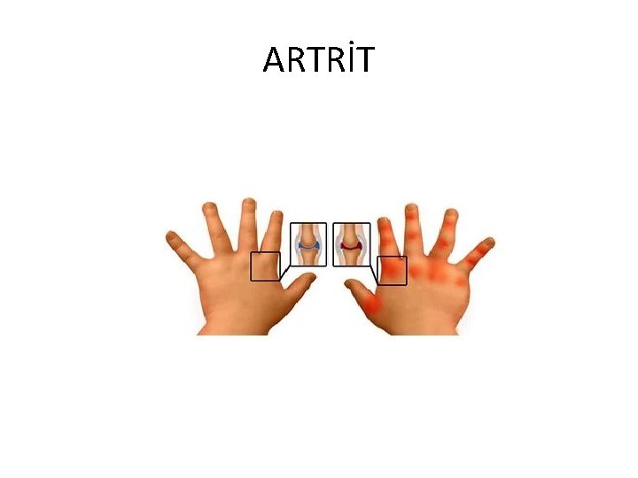 ARTRİT 