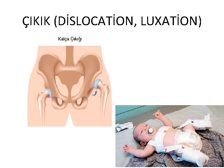 ÇIKIK (DİSLOCATİON, LUXATİON) 