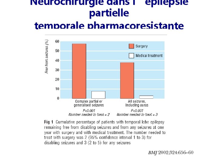 Neurochirurgie dans l’épilepsie partielle temporale pharmacoresistante 