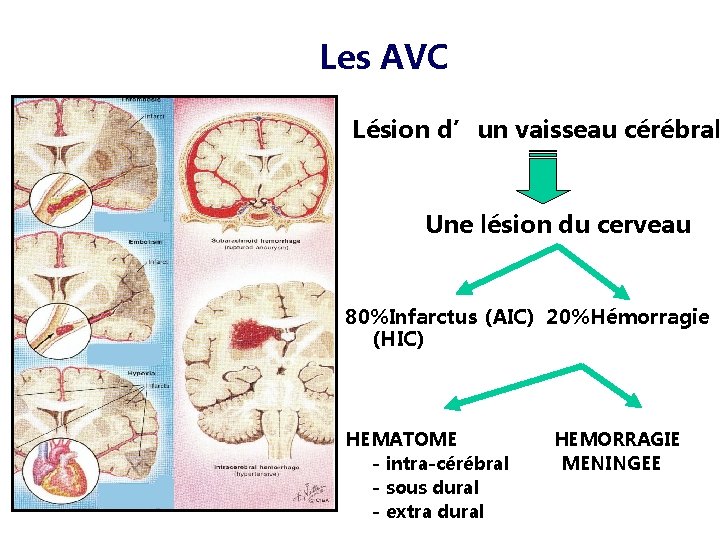 Les AVC Lésion d’un vaisseau cérébral Une lésion du cerveau 80%Infarctus (AIC) 20%Hémorragie (HIC)