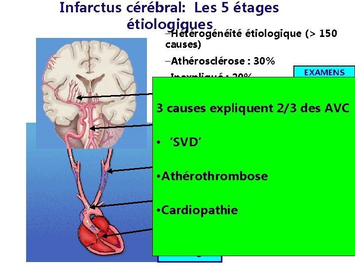 Infarctus cérébral: Les 5 étages étiologiques –Hétérogénéité étiologique (> 150 causes) –Athérosclérose : 30%