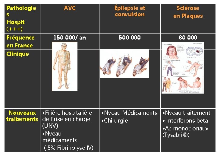 Pathologie s Hospit (+++) AVC Épilepsie et convulsion Sclérose en Plaques Fréquence en France