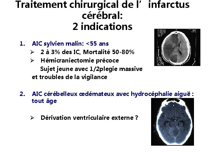 Traitement chirurgical de l’infarctus cérébral: 2 indications 1. AIC sylvien malin: <55 ans 2