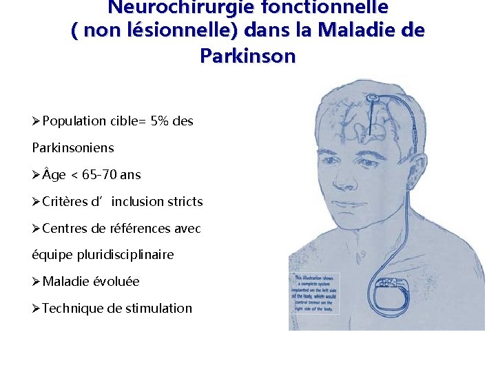 Neurochirurgie fonctionnelle ( non lésionnelle) dans la Maladie de Parkinson Population cible= 5% des
