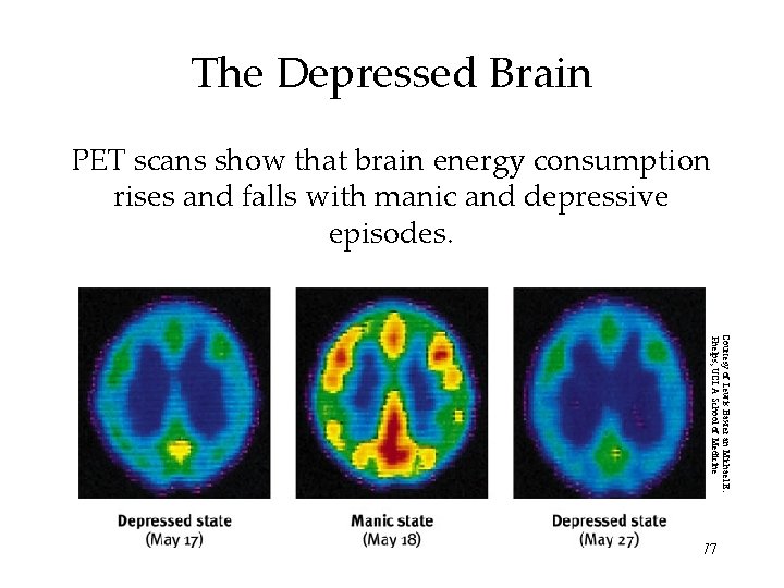 The Depressed Brain PET scans show that brain energy consumption rises and falls with