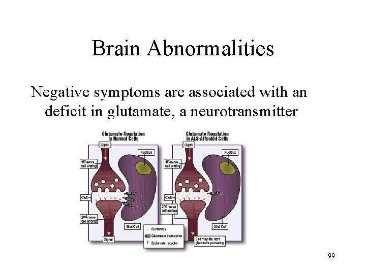 Brain Abnormalities Negative symptoms are associated with an deficit in glutamate, a neurotransmitter 99