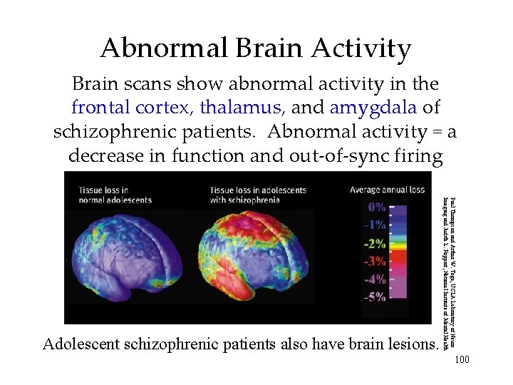 Abnormal Brain Activity Brain scans show abnormal activity in the frontal cortex, thalamus, and