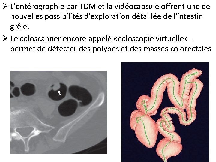 Ø L'entérographie par TDM et la vidéocapsule offrent une de nouvelles possibilités d'exploration détaillée