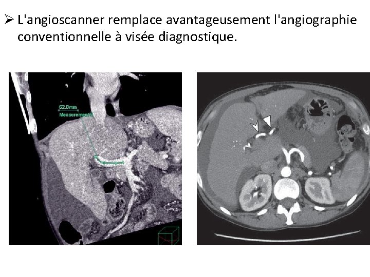 Ø L'angioscanner remplace avantageusement l'angiographie conventionnelle à visée diagnostique. 