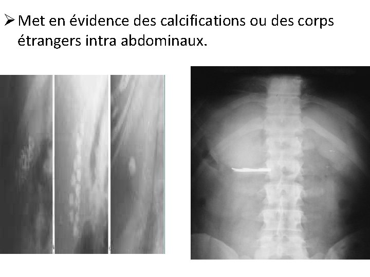 Ø Met en évidence des calcifications ou des corps étrangers intra abdominaux. 
