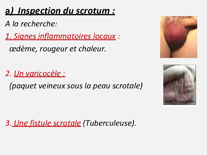 a) Inspection du scrotum : A la recherche: 1. Signes inflammatoires locaux : œdème,