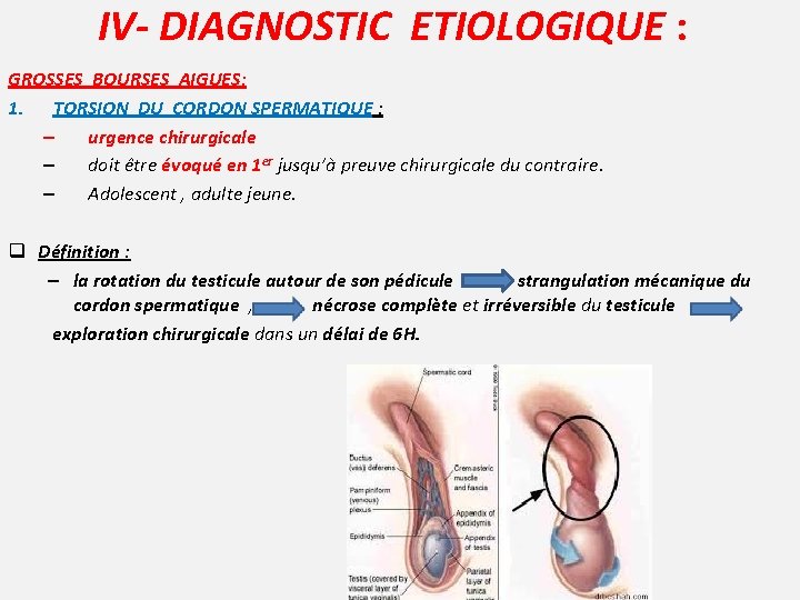 IV- DIAGNOSTIC ETIOLOGIQUE : GROSSES BOURSES AIGUES: 1. TORSION DU CORDON SPERMATIQUE : –