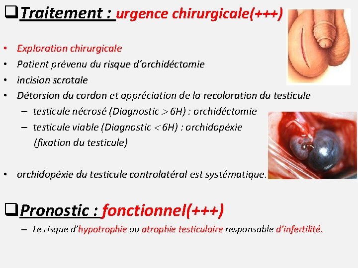 q. Traitement : urgence chirurgicale(+++) • • Exploration chirurgicale Patient prévenu du risque d’orchidéctomie