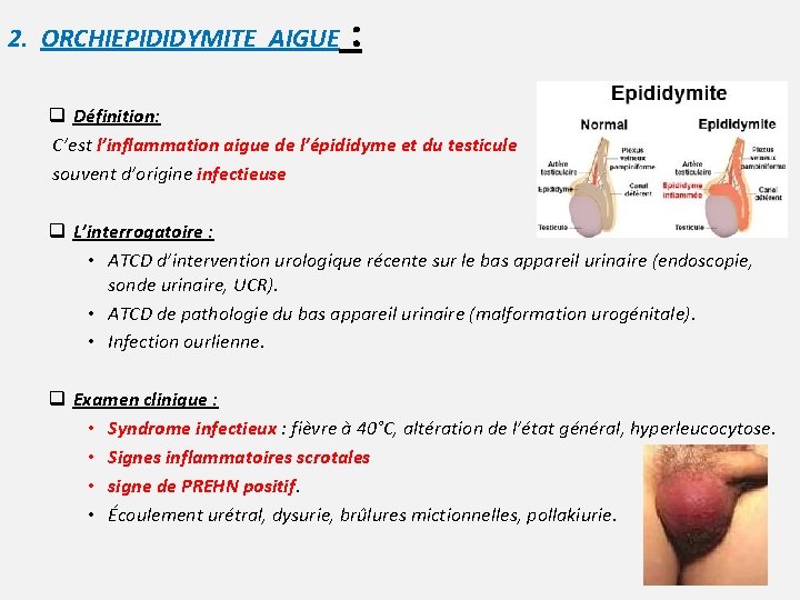 2. ORCHIEPIDIDYMITE AIGUE : q Définition: C’est l’inflammation aigue de l’épididyme et du testicule