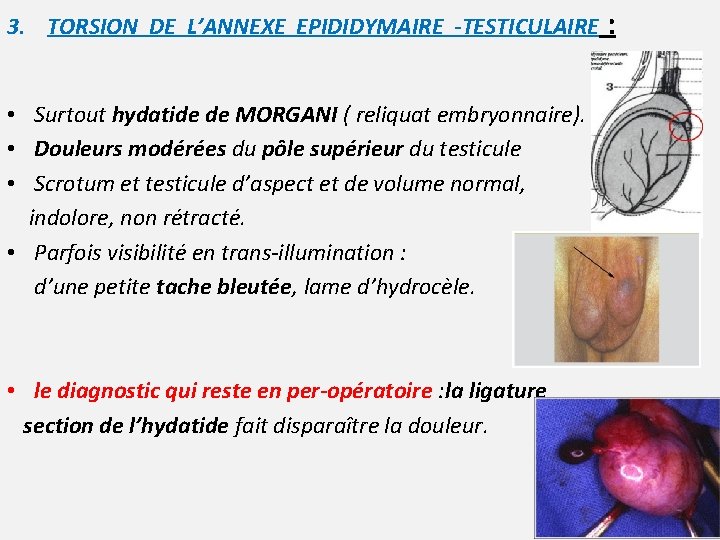 3. TORSION DE L’ANNEXE EPIDIDYMAIRE -TESTICULAIRE • Surtout hydatide de MORGANI ( reliquat embryonnaire).