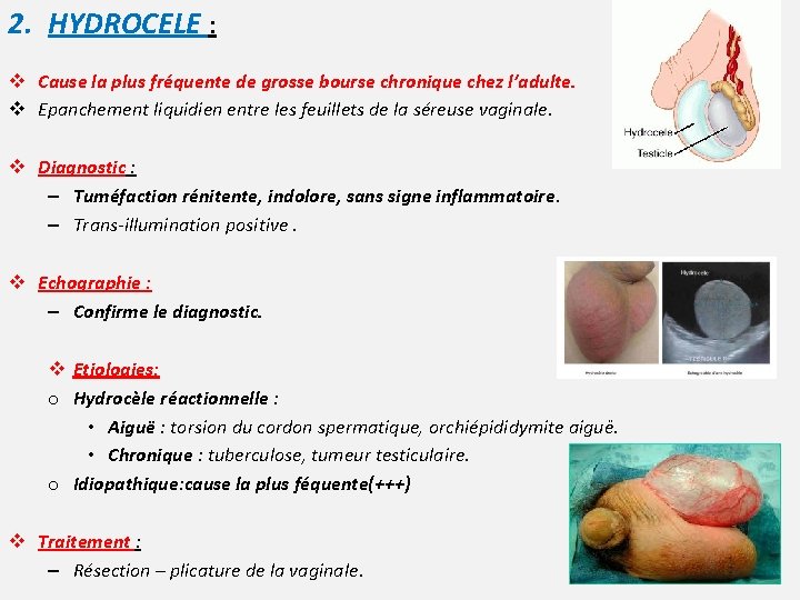 2. HYDROCELE : v Cause la plus fréquente de grosse bourse chronique chez l’adulte.