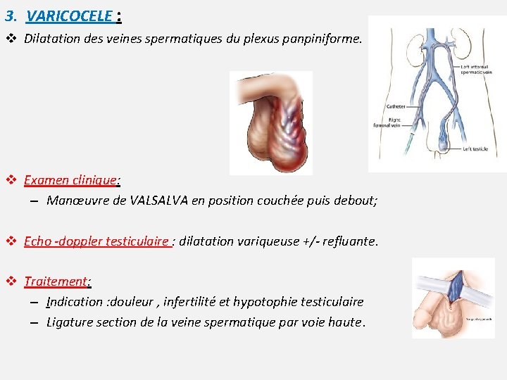 3. VARICOCELE : v Dilatation des veines spermatiques du plexus panpiniforme. v Examen clinique: