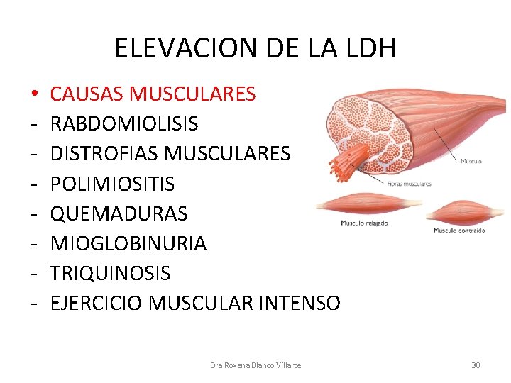 ELEVACION DE LA LDH • - CAUSAS MUSCULARES RABDOMIOLISIS DISTROFIAS MUSCULARES POLIMIOSITIS QUEMADURAS MIOGLOBINURIA