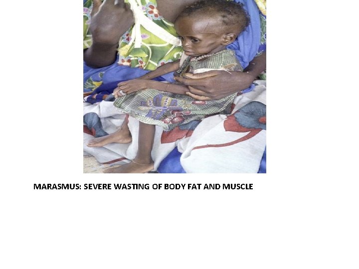 MARASMUS: SEVERE WASTING OF BODY FAT AND MUSCLE 