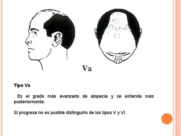 Tipo Va Es el grado más avanzado de alopecia y se extiende más posteriormente.