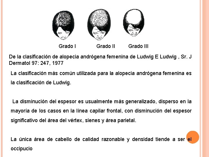Grado III De la clasificación de alopecia andrógena femenina de Ludwig E Ludwig ,