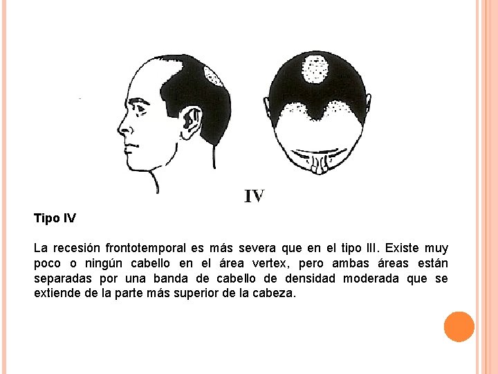 Tipo IV La recesión frontotemporal es más severa que en el tipo l. II.