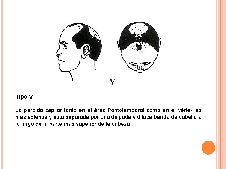 Tipo V La pérdida capilar tanto en el área frontotemporal como en el vértex