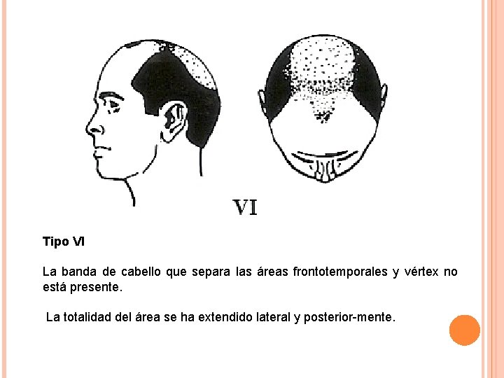 Tipo VI La banda de cabello que separa las áreas frontotemporales y vértex no