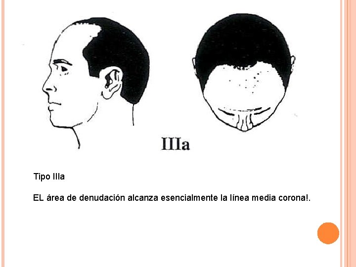 Tipo IIla EL área de denudación alcanza esencialmente la línea media corona!. 