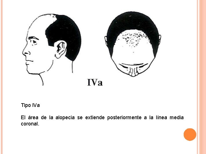 Tipo l. Va El área de la alopecia se extiende posteriormente a la línea